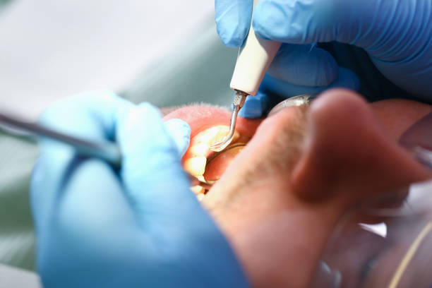 Best Emergency Dental Extractions in Fruitville, FL